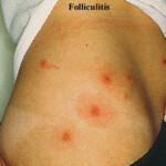 Hot Tub Folliculitis Spa Pool Folliculitis Academic Dermatology