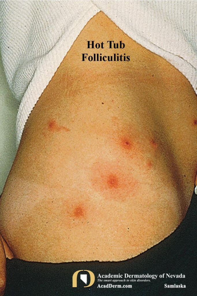 Hot Tub Folliculitis Spa Pool Folliculitis Academic Dermatology 