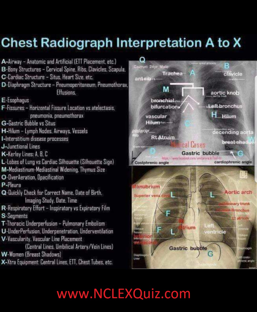 Nursing Mnemonic How To Read A Chest Xray Cheat Sheet NCLEX Quiz