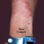 Tinea Corporis Ringworm Tinea Circinata Academic Dermatology Of