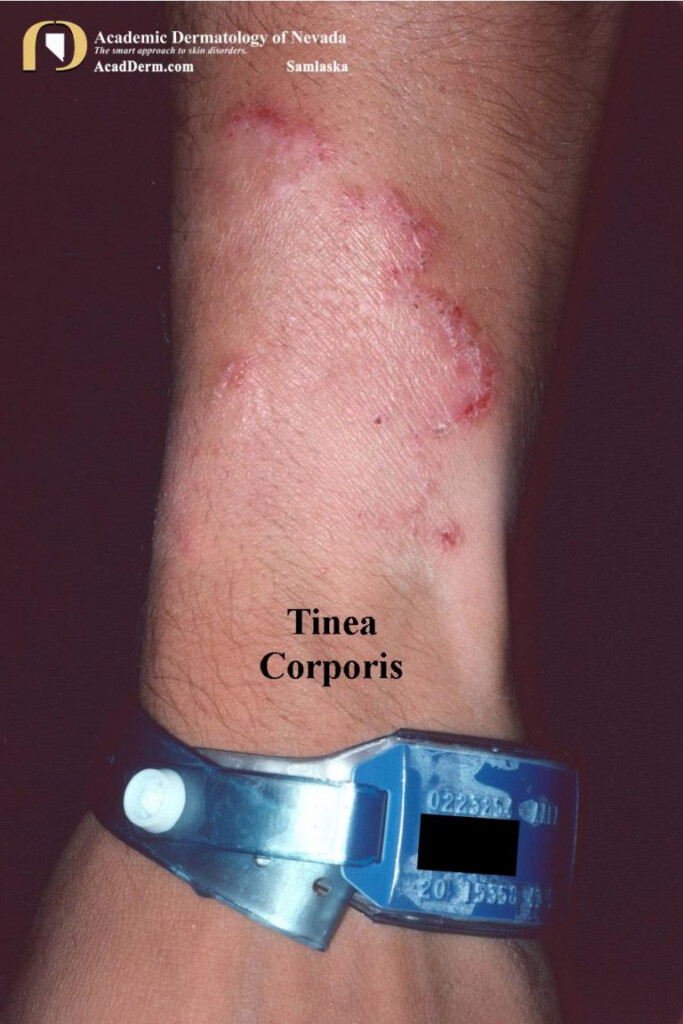 Tinea Corporis Ringworm Tinea Circinata Academic Dermatology Of 